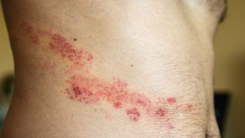 <ul><li><p><strong><u>Unilateral</u></strong> <strong>Rash with tiny bumps</strong></p></li><li><p>Pain (moderate to severe)</p></li><li><p>Patient <strong>history </strong>of <strong>chickenpox</strong></p></li><li><p>Symptoms within 72 hours</p></li></ul><p></p>