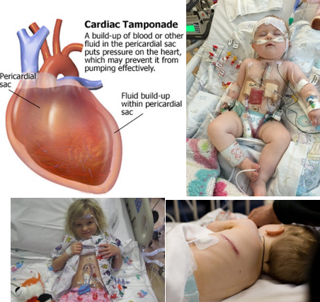 <ul><li><p class="">Maintain cardiac output.</p></li><li><p class=""><strong><u>Prevent Cardiac Tamponade</u>:</strong></p><ul><li><p class=""><strong>MEDICAL EMERGENCY</strong>:</p><ul><li><p class="">Hypotension</p></li><li><p class="">Muffled heart sounds (beating through water)</p></li><li><p class="">Decreased systemic perfusion</p></li><li><p class="">Sudden cessation of chest tube drainage (just stops)</p></li><li><p class="">Narrowing pulse pressures</p></li></ul></li></ul></li><li><p class="">Manage temporary pacing wires.</p></li><li><p class="">Maintain fluid and electrolyte balance.</p></li><li><p class="">Promote respiratory function.</p></li><li><p class="">Prevent hemorrhage and arrhythmias.</p></li><li><p class="">Monitor neurological functioning.</p></li><li><p class="">Prevent infection (incision care).</p></li><li><p class="">Manage sedation and pain.</p></li><li><p class="">Manage nutrition.</p></li><li><p class="">Provide psychosocial support.</p></li></ul><p></p>