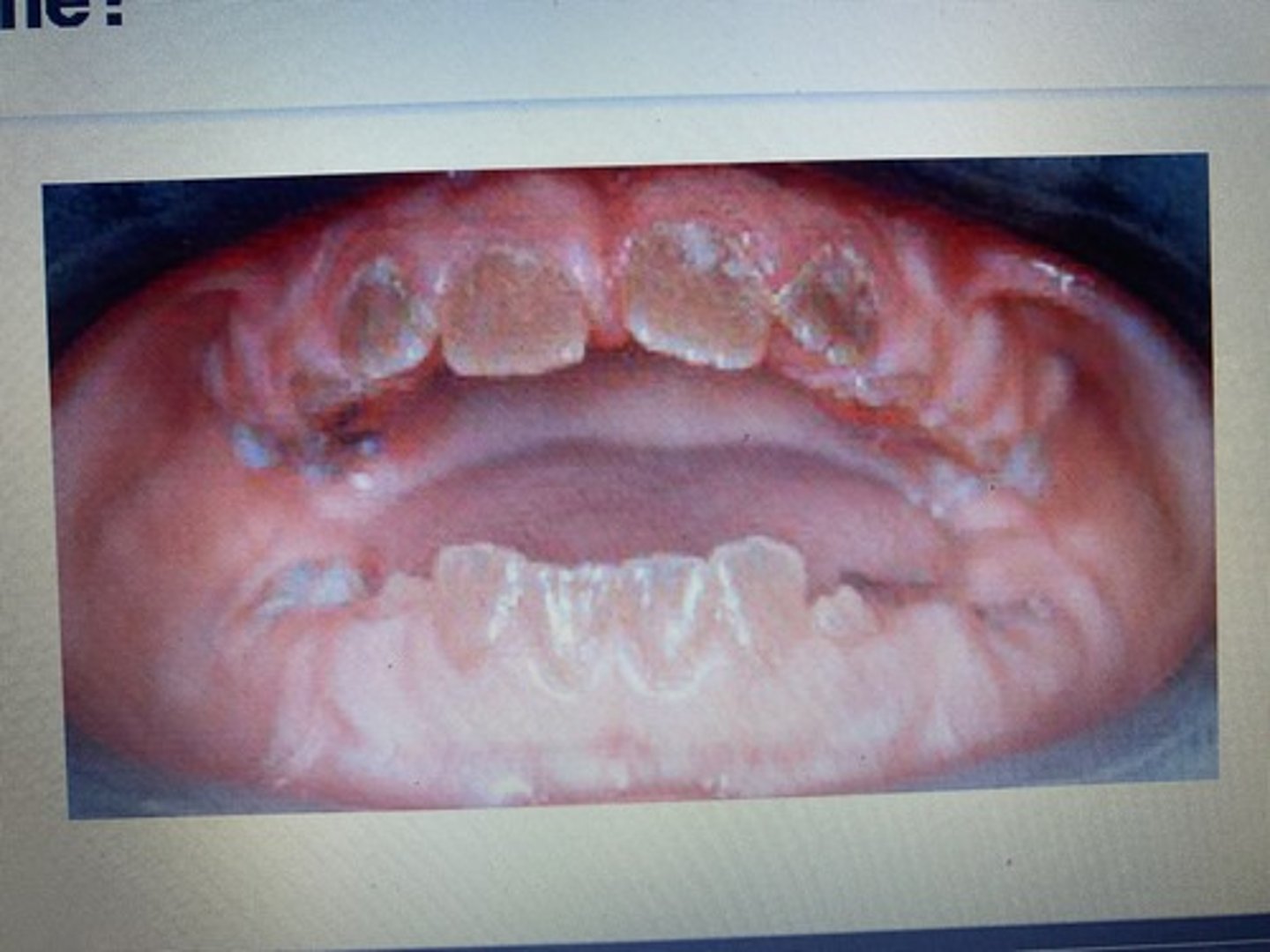 <p>Dentinogenisis Imperfecta (This is a pathological condition in which familial history plays a role in diagnosis. This condition is hereditary)</p>