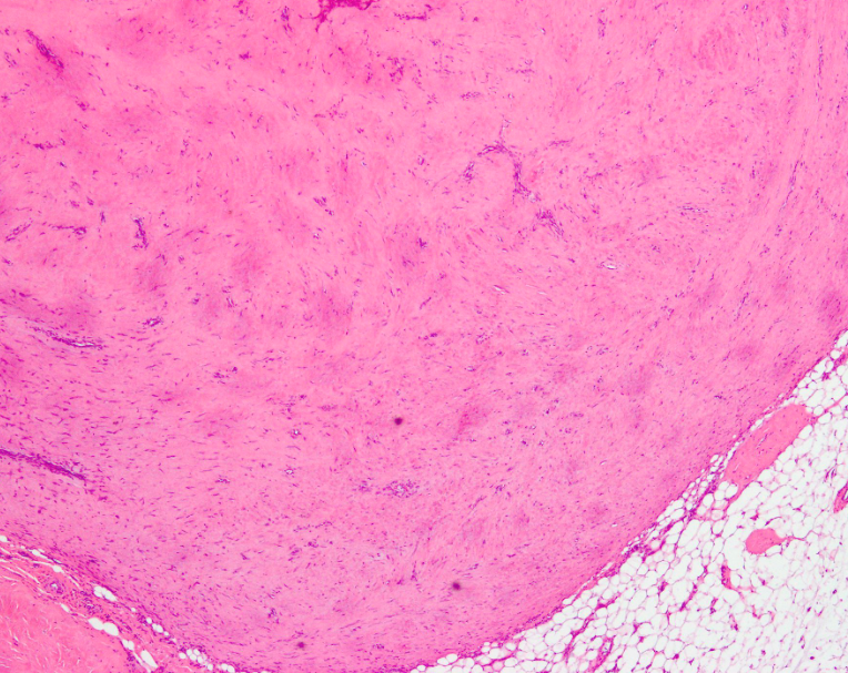 <p>Lésion poignet homme de 30 ans </p><p>1) Diagnostic</p><p>2) Clinique (âge, localisation) </p><p>3) Histo </p>