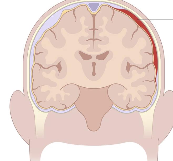 <p>rupture of veins → Collection of blood b/w the inner surface of the <strong><u>dura mater &amp; surface</u></strong> of the brain </p>