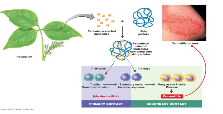 <ul><li><p>first contact: limited response occur and there is no resulting dermatitis </p><ul><li><p>memory T cells are produced </p></li><li><p>second contact: memory T cells differentiate into activated cytotoxic T cells</p><ul><li><p>causes contact dermatitis → look like abnormal skin cells</p></li></ul></li></ul></li></ul><p></p>