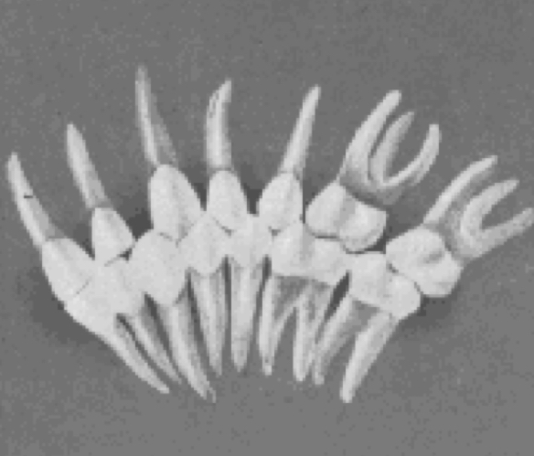 <p>extreme form of overtreatment, allowing excessive space for each tooth to be intercuspally placed</p>