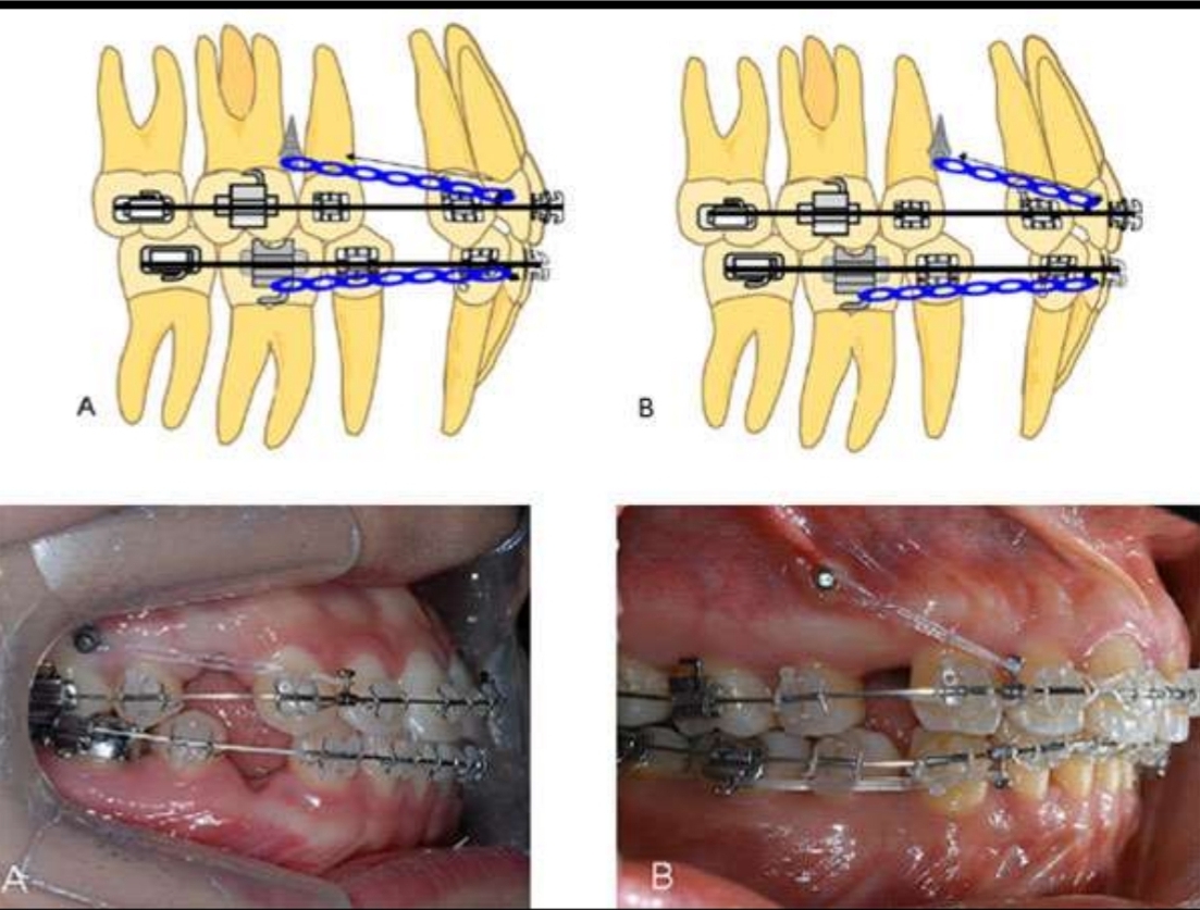 <p><strong>Root control</strong> (and close/open space)</p><p class="has-focus"><strong>Rectangular archwire</strong></p>