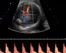 <ol><li><p>What is being dopplered here?</p></li><li><p>Is the waveform considered normal or abnormal for this vessel?</p></li></ol><p></p>