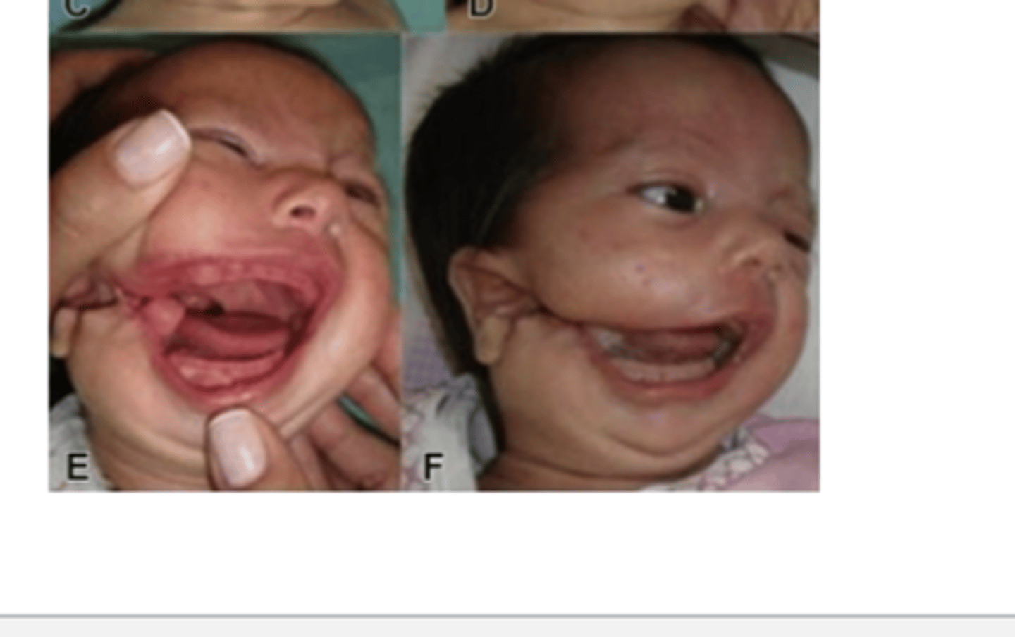 <p>Lateral facial clefts (rare) are formed from the lack of fusion of what? (2)</p>
