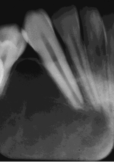 <p>What are the edge borders of Central Giant Cell Granuloma (CGCG)?</p>