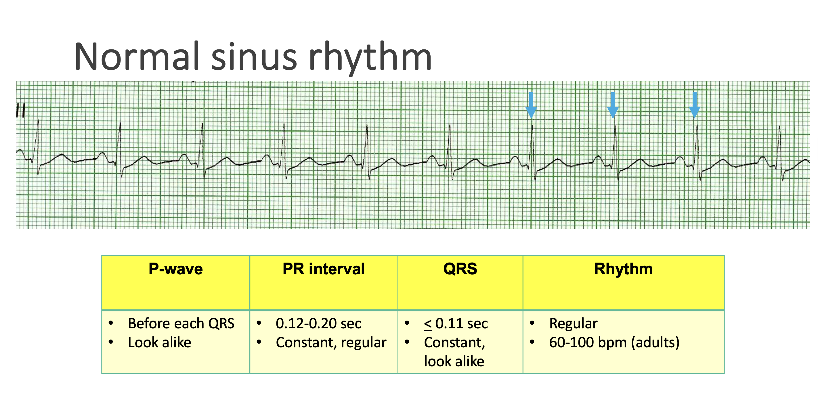 <p>Normal Sinus Rhythm</p>