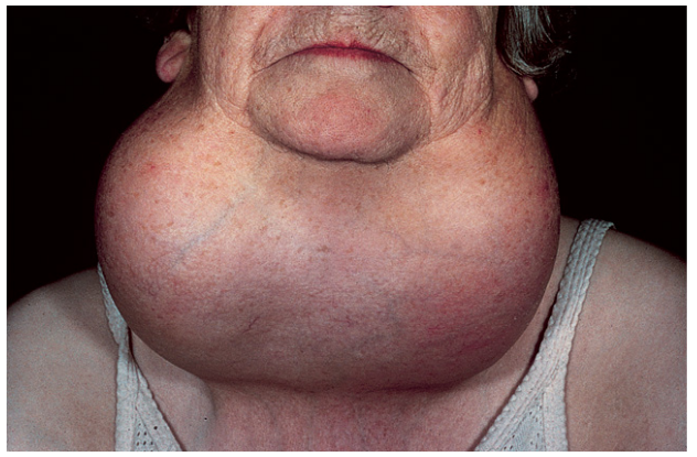 <p><span style="background-color: transparent;"><span>Goiters can result from hyposecretion or hypersecretion of </span><u><span>thyroid hormone</span></u></span></p>