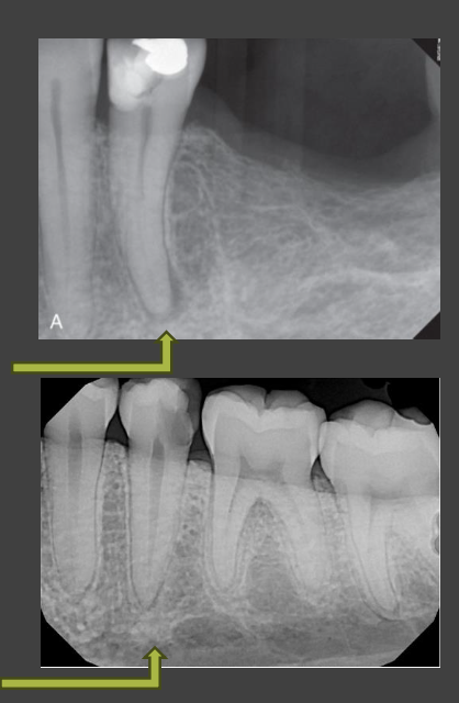 <ul><li><p>Radiologic diagnosis for inflammatory process associated with bone resorption at tooth apex</p></li><li><p>Appears as localized area of increased radiolucency</p></li><li><p>Rarefying refers to loss of bone mineralization</p></li><li><p>Osteitis refers to inflammation of bone</p></li></ul><p></p>