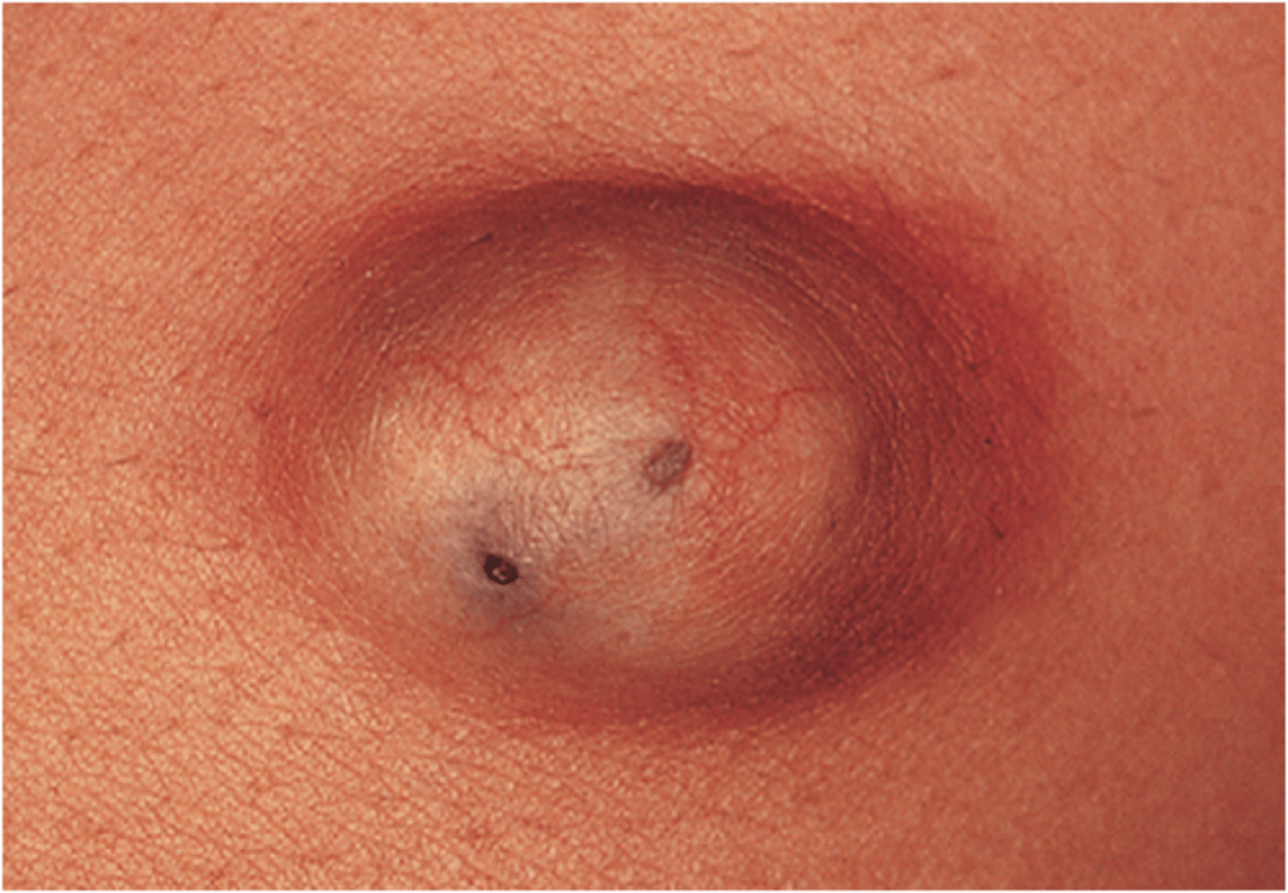 <p>-<strong>dome-shaped, firm, skin-colored nodule that is freely movable on palpation and sometimes has a small, dilated punctum</strong></p><p><strong>-filed with thick, cheesy material (keratin and lipid-rich debris) with a foul odor that can be expressed</strong></p><p>-can be well-defined or it may have an irregular border and surface d/t prior rupture, scarring, and regrowth</p><p>-benign and usually asx, can be painful</p>