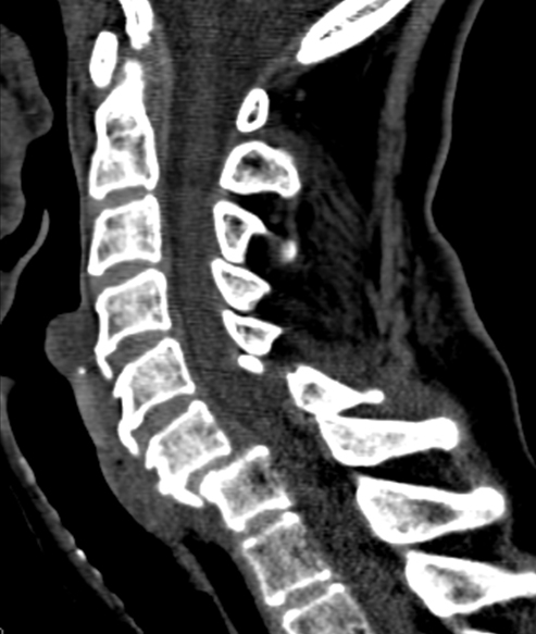 <p>fell down stairs, weakness of elbow extension &amp; wrist flexion</p><p>decreased pain sensation in index &amp; middle fingers</p>