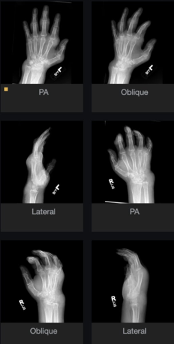 <p>What are the stages of this disease?</p>