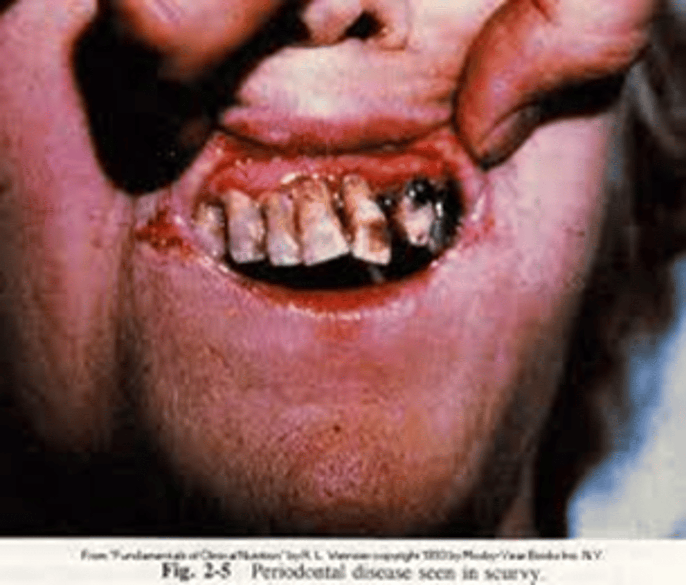 <p>scurvy characterized by weakness, anemia, bruising, bleeding gums, subcutaneous hemorrhage, and loose teeth</p><p>Defect in collagen formation: needed for cofactor for enzyme</p><p>arching bones, joints, and muscles in adults</p><p>rigid position, pain (infants)</p>