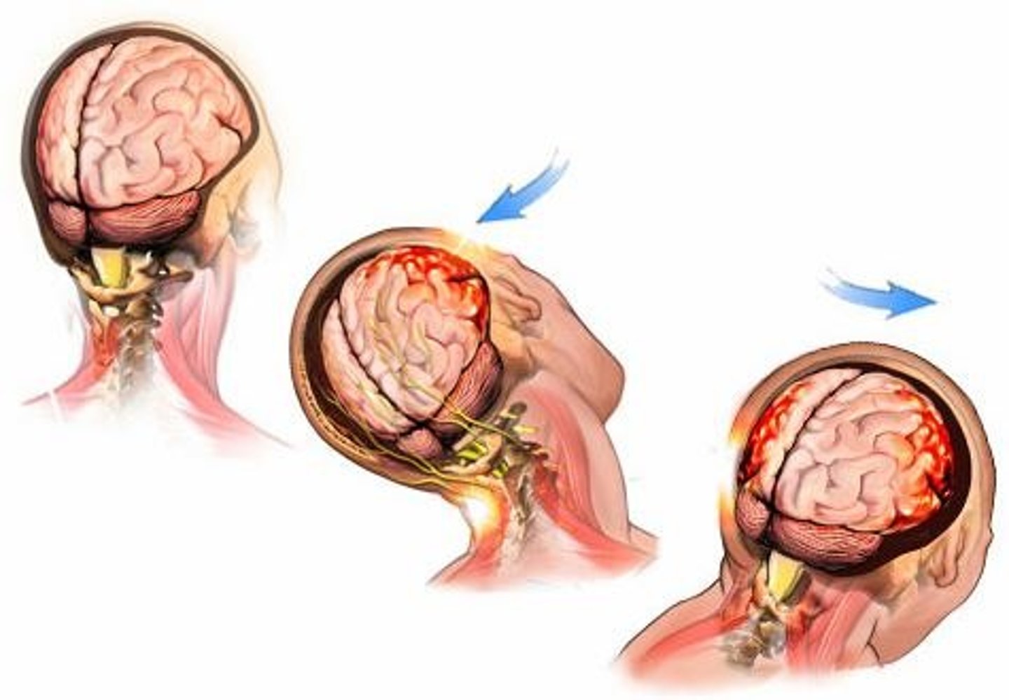 <p>Examples include concussions, contusions, and cerebral edema</p>