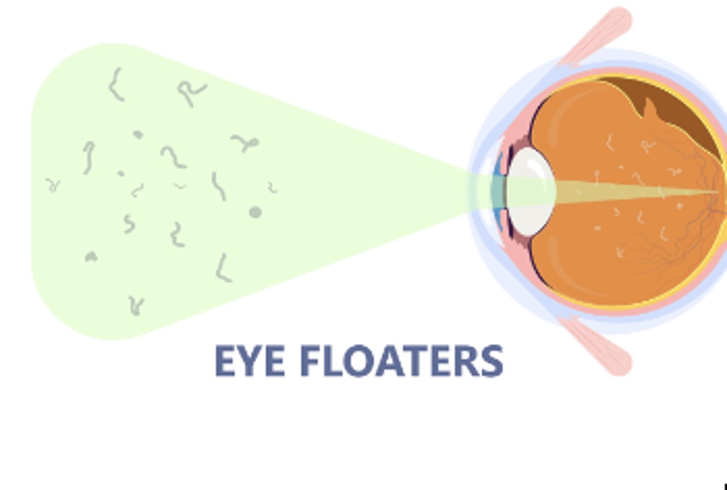 <p>Clumping of protein fibers in vitreous humor which usually comes with age</p>