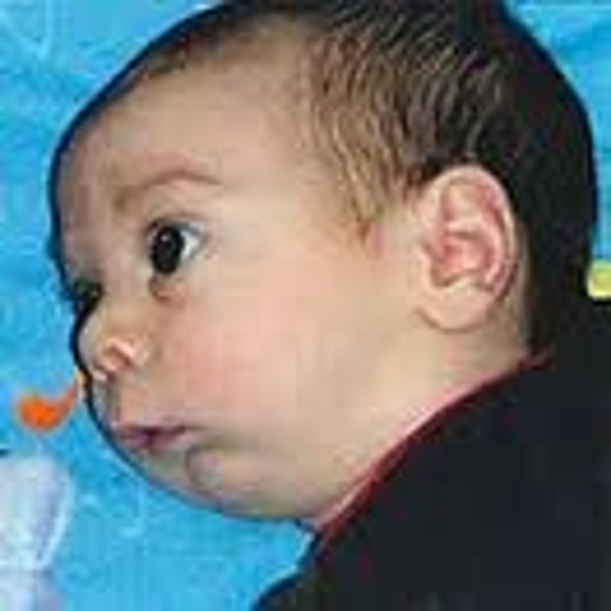 <p>An unusually small jaw, which alters tongue position and can induce problems with swallowing</p>