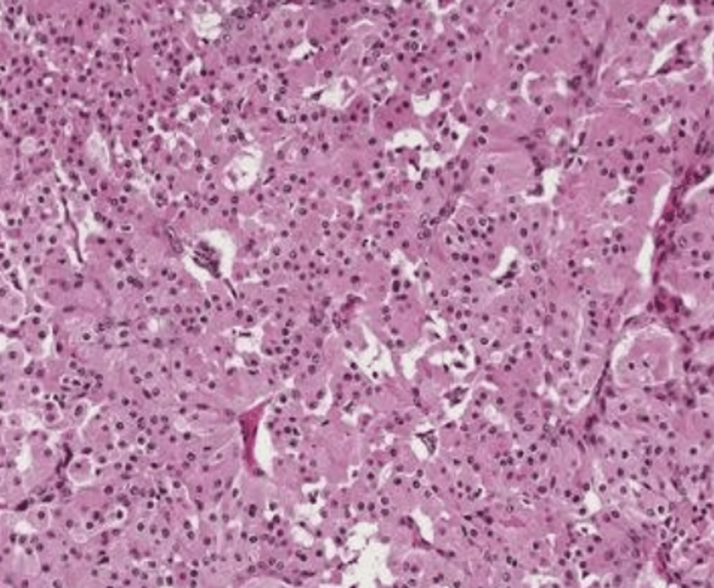 <p>These histologic characteristics are indicative of what oral pathology?</p><p>-Large polyhedral cells with abundant granular cytoplasm -- Mitochondria!</p><p>-Cells are separated by thin fibrous septal</p><p>*Very pink histology~oncocytic means eosinophilic cytoplasm which always stains PINK!</p>