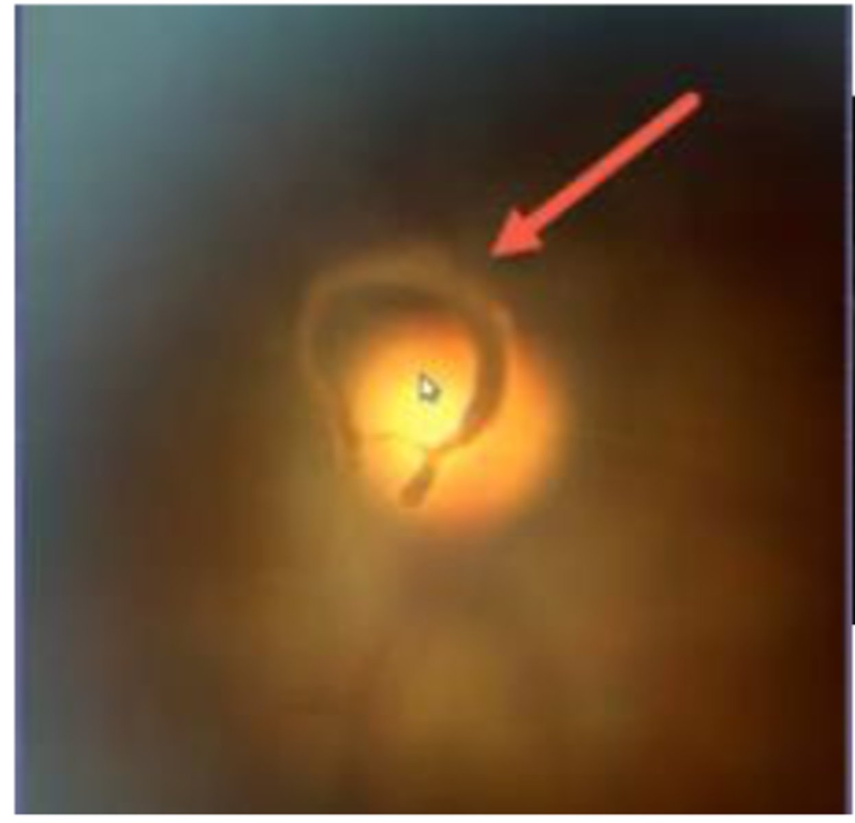 <p>A sign of posterior vitreous detachment</p>