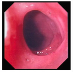 <p>oesophageal web, dysphagia, iron def anemia</p><p>iron supplement…web dilatation</p>