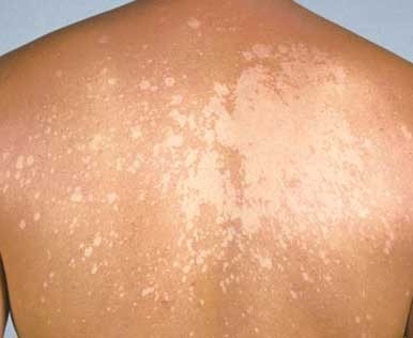 <p>pityriasis versicolor</p><p>-chronic, asymptomatic yeast infection w/ scaling oval patches</p><p>-affected skin will lighten</p><p>-oily areas</p>