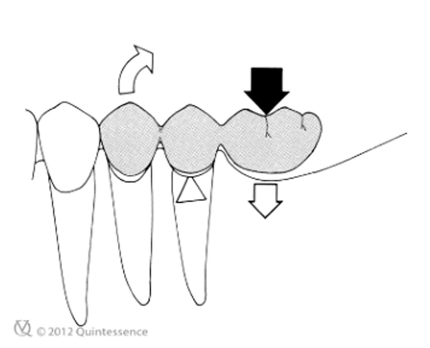 <p>it places a great deal of stress on the mesial abutment</p><p>- instead, you can make the pontic smaller (like premolar size) to minimize stress on abutments</p>