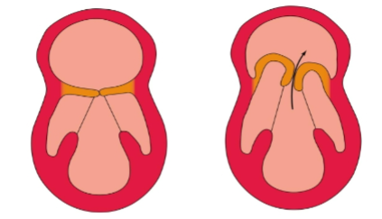 <p>leaflets of the mitral valve bulges into the left atrium when ventricle contracts</p><p></p>