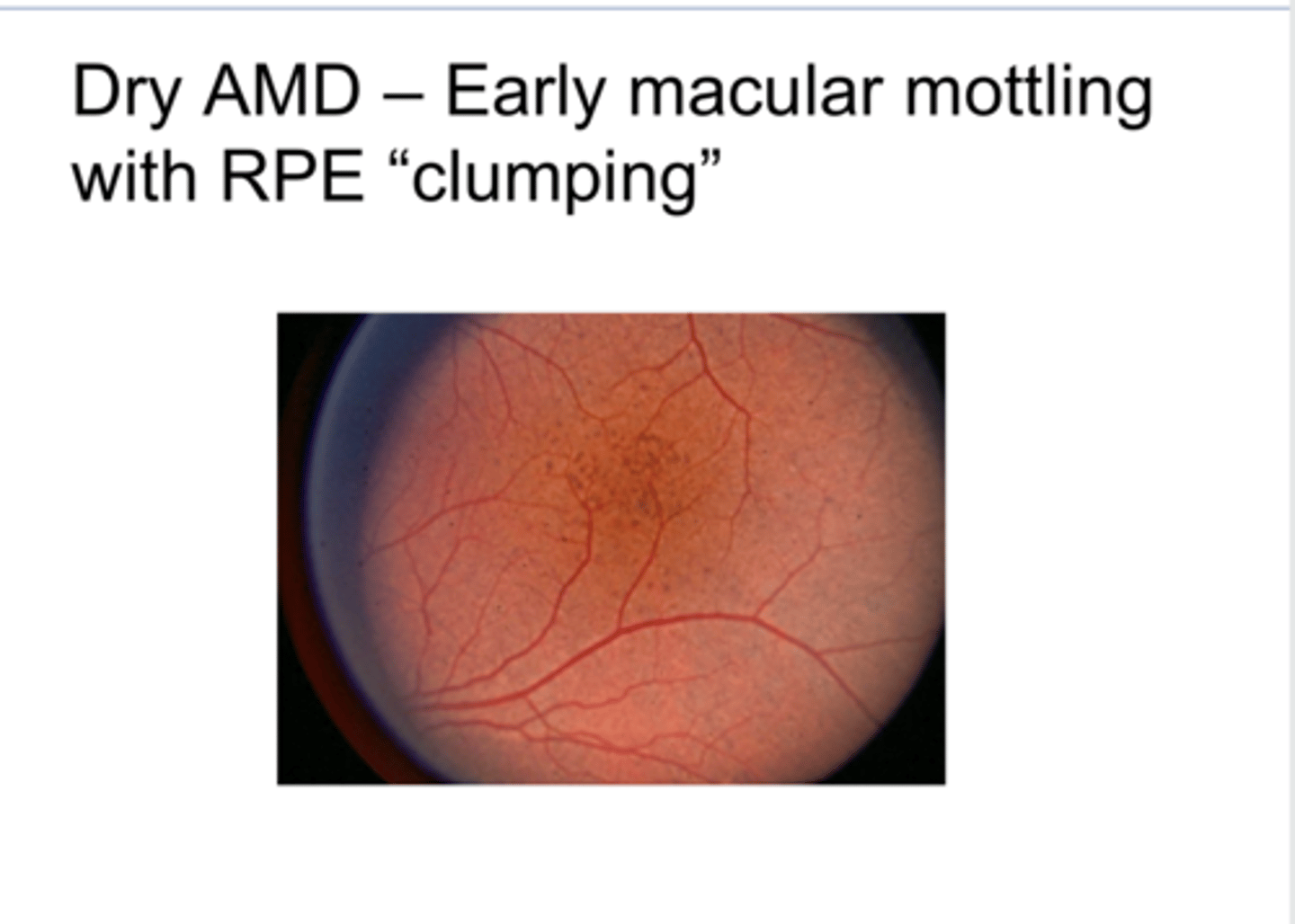 <p>Can you get these pigmentary changes from other diseases besides AMD?</p>