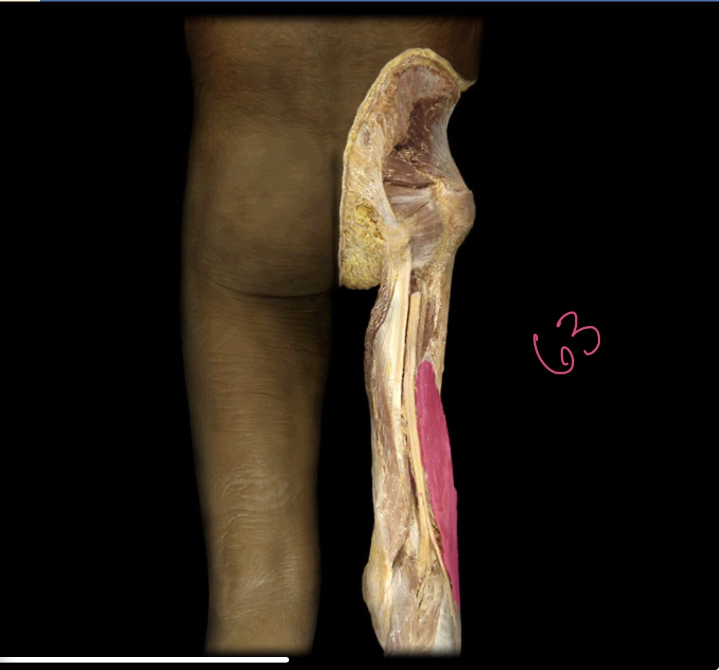 <p>Short head of biceps femoris</p>
