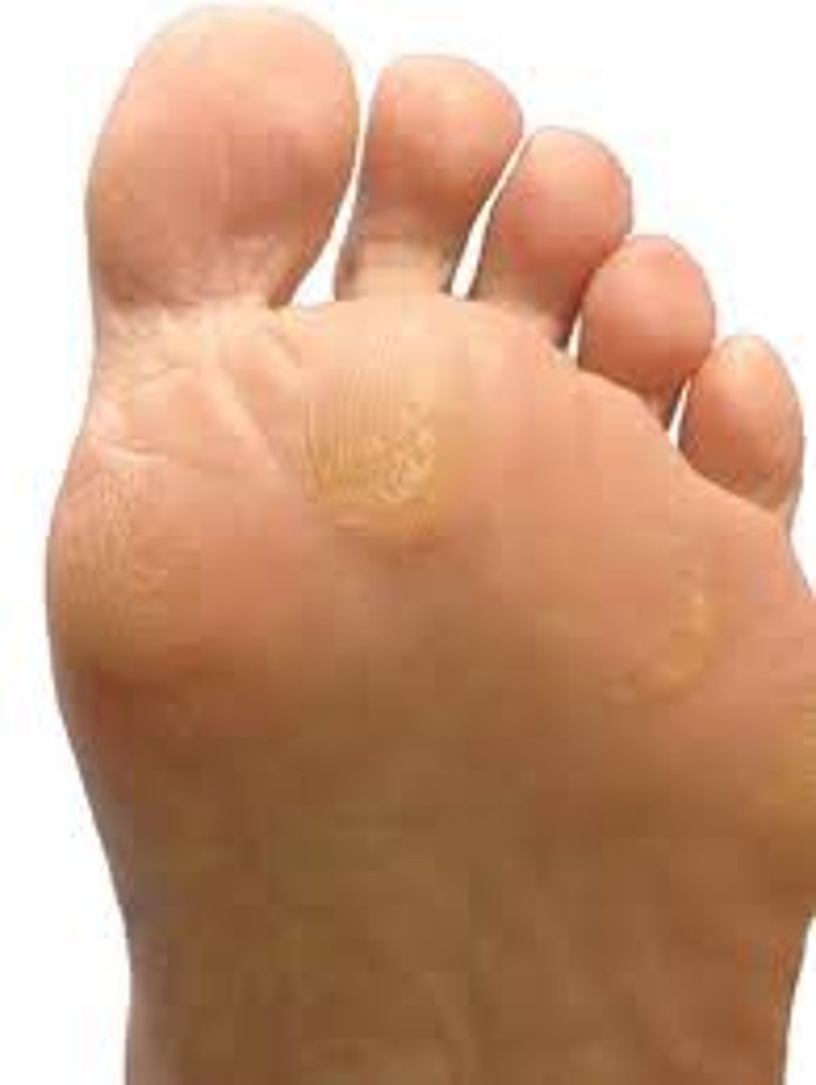 <p>calluses</p><p>- NOT painful</p><p>**corn = painful</p>