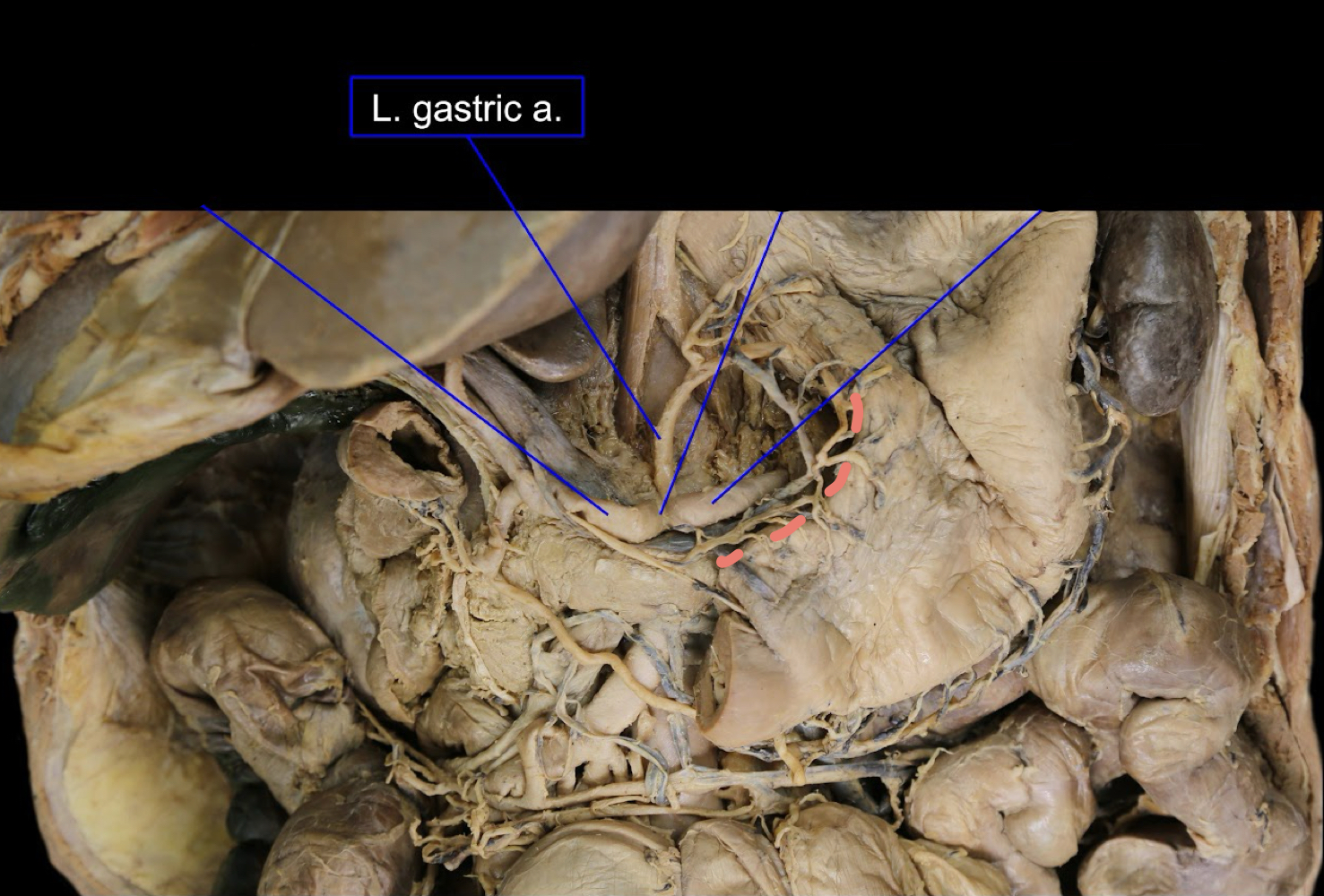 <p>A). lesser curvature of the stomach<br>B). left gastric arteries</p>