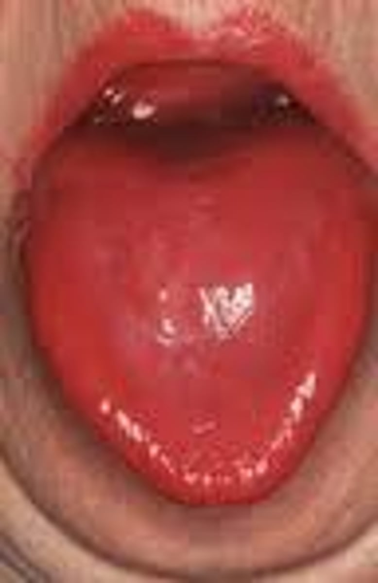 <p>Inflammation of the tongue, seen in severe Megaloblastic Anemia</p>