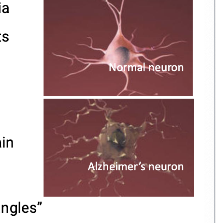 <ul><li><p>more complex than PD b/c multiple cell types are most likely involved</p></li><li><p>most common cause of dementia</p></li><li><p>complex disease that affects the nerves of many parts of the brain</p></li><li><p>makes effective treatment challenging</p></li><li><p>precise cause of the disease = unknown</p></li><li><p>people with alzheimers have an abnormal build up of <u>certain proteins</u> in the brain</p><ul><li><p>include <strong>amyloid beta</strong> which clumps together to form “plaques” and <strong>tau</strong> which gets twisted into protein “tangles”</p></li></ul></li><li><p>one theory is that the plaque prevents nerve cells from communicating properly while tangles make it difficult for the cells to get the nutrients they need</p></li><li><p>role for these plaques = unclear as recent studies show that they might NOT be as important as previously thought in the disease</p></li></ul><p></p>
