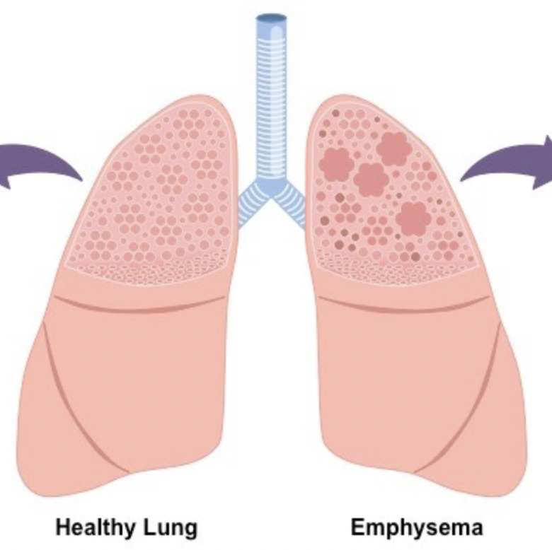 <p>Respiratory disease, caused by smoking or air pollution. Consequences are loss of elasticity in lungs, reduced surface area for gas exchange and difficulty to exhale air. Inflammatory response.</p>