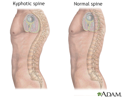<p>Kyphotic Curve</p>