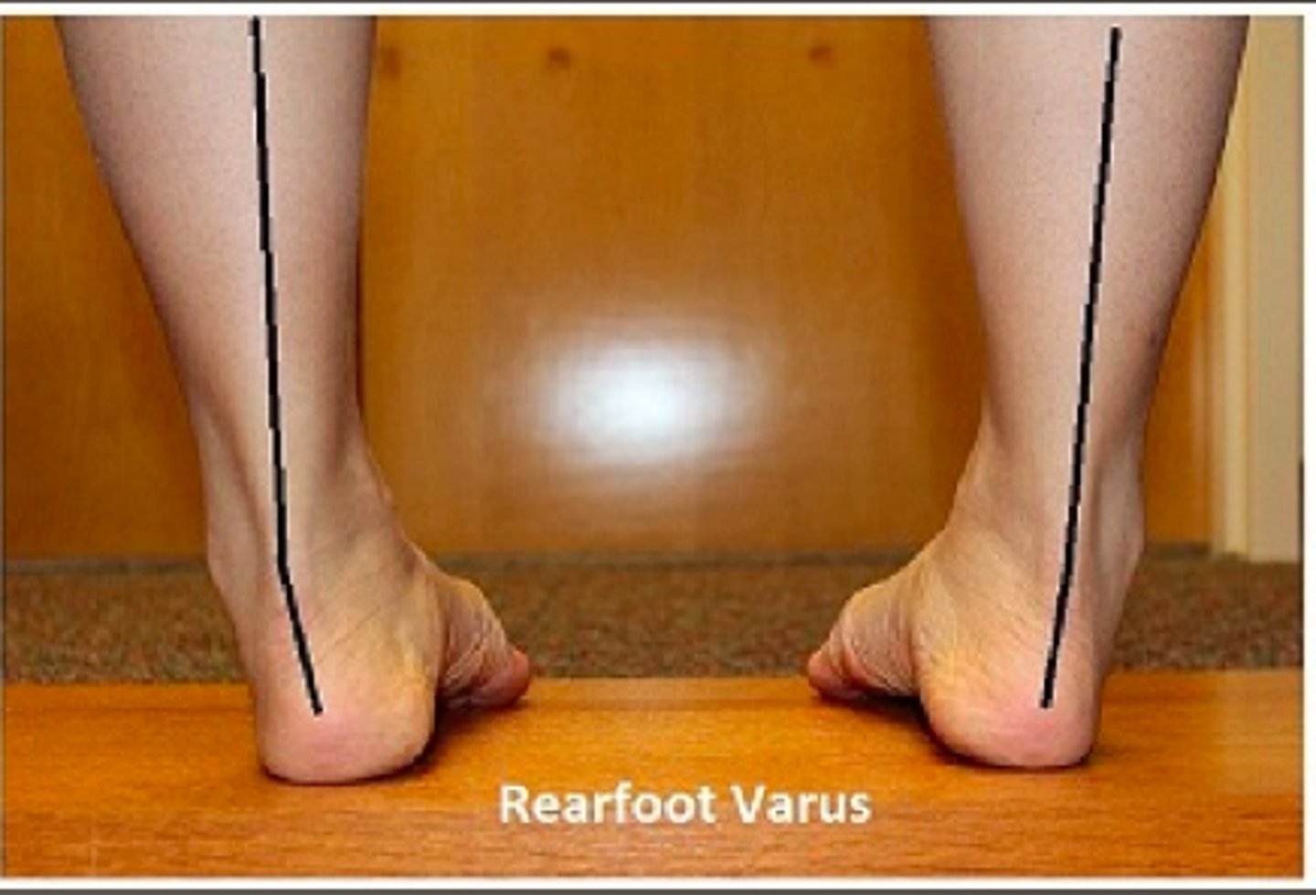 <p>LCL at risk of damage, deviates medially</p>