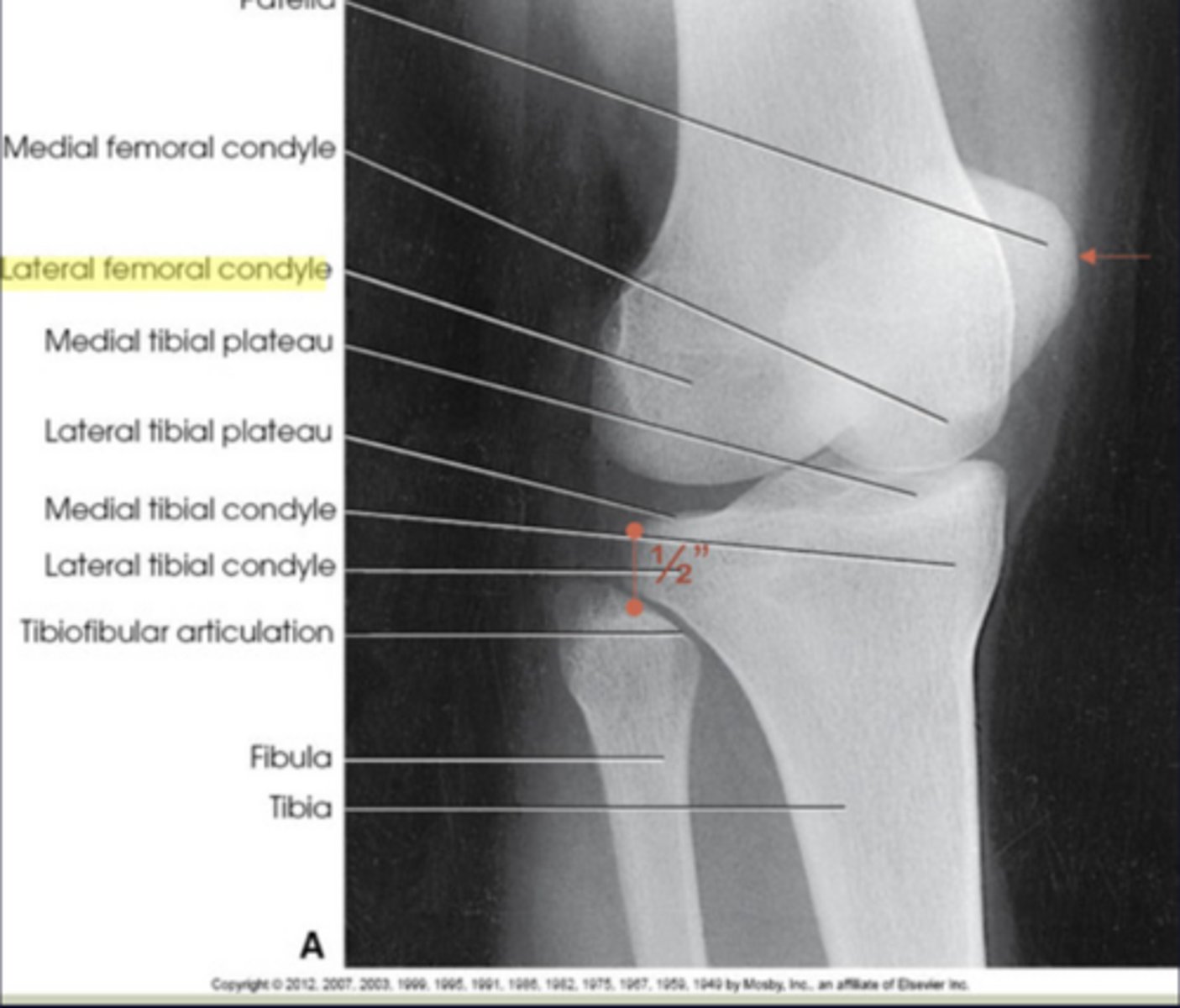 <p>Projects slightly beyond the medial side of the femoral condyle</p>