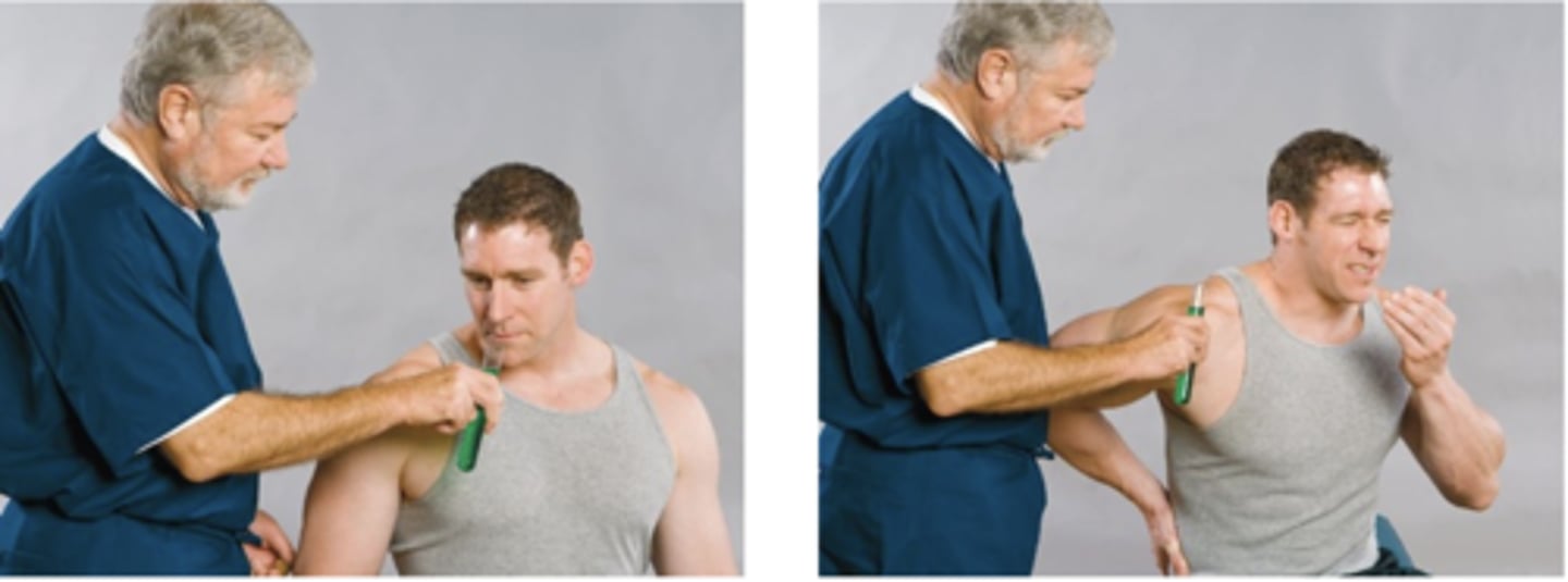 <p>In the attached diagram, the orthopedic test/sign being performed is called _____ and would be positive in which condition?</p><p>- Lewin punch - bone contusion</p><p>- Lewin-gaenslen's test - myalgia</p><p>- Lewing standing test - hamstring tightness</p><p>- Lewin snuff - disc herniation</p>