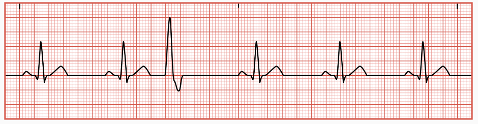 <p>occur when early electrical impulses, originating from irritated ventricular cells are transmitted before the next normal impulse is expected from the SA node</p>