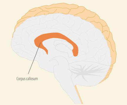 <p><strong><u>Lateralisation</u></strong></p><p>Lateralisation refers to the fact that the two halves of the brain have different functional specialisations. E.g. language is lateralised to the left hemisphere.</p><p>However this raises an important question: if language is located in the left hemisphere, how can we talk about things that are experiences in the right hemisphere, for example face recognition.</p><p>⤷ This is because the two hemispheres are connected by the corpus callosum which allows information received by one hemisphere to be sent to the other hemisphere.</p><p>We are able to study the different abilities of the two hemispheres because there was a treatment for severe epilepsy where surgeons cut the corpus callosum. These patients are referred to as split-brain patients.</p><p>See image attached.</p><p></p><p><strong><u>Split-brain research, Sperry and Gazzaniga (1967)</u></strong></p><p><strong>(Btw, split-brain research is the same as research into lateralisation of the brain).</strong></p><p>The aim was to test the capabilities of the two hemispheres.</p><p>Information from the left visual field goes to the right hemisphere and information from the right visual field goes to the left hemisphere. But, in split-brain patients, the information presented in one hemisphere has no was of travelling to the other hemisphere.</p><p>Therefore, they had split-brain patients fixate on a dot in the centre of a screen, or they would split their vision with a tachistoscope, while information was presented to either the left or right visual field.</p><p></p><p>They did a “describe what you see” test where the patient was flashed a picture, e.g. of a dog, to the right visual field and asked what they had seen. They would answer ‘dog’. However, if a picture of a cat was flashed to the left visual field the patient would say that he or she sees nothing. This is because information from the left visual field is processed by the right hemisphere (as can be seen in the picture), but as it has no language centre, cannot respond verbally. The left hemisphere, which does have a language centre, does not receive information about seeing the picture of a cat, therefore cannot say that it has seen it.</p><p></p><p>They also did a tactile test where an object was placed in the patient’s left hand. The findings showed that the patient could not describe what they felt. This is because it was processed in the right hemisphere which has no language centre.</p><p></p><p>They did a drawing task where the left-hand (controlled by the right hemisphere) would consistently draw clearer and better pictures than the right hand, even with right-handed patients. This demonstrated the superiority of the right hemisphere when it comes to visual motor tasks.</p><p></p><p>Split-brain research has taught us that:</p><ul><li><p>There are differences between the two hemispheres</p></li><li><p>Left-hemisphere is responsible for speech and language</p></li><li><p>Right-hemisphere is responsible for visual-spatial processing and facial recognition.</p></li><li><p>However, it hasn’t shown us that the brain is organised into discrete regions with specific sections responsible for specific tasks.</p></li></ul><p></p>