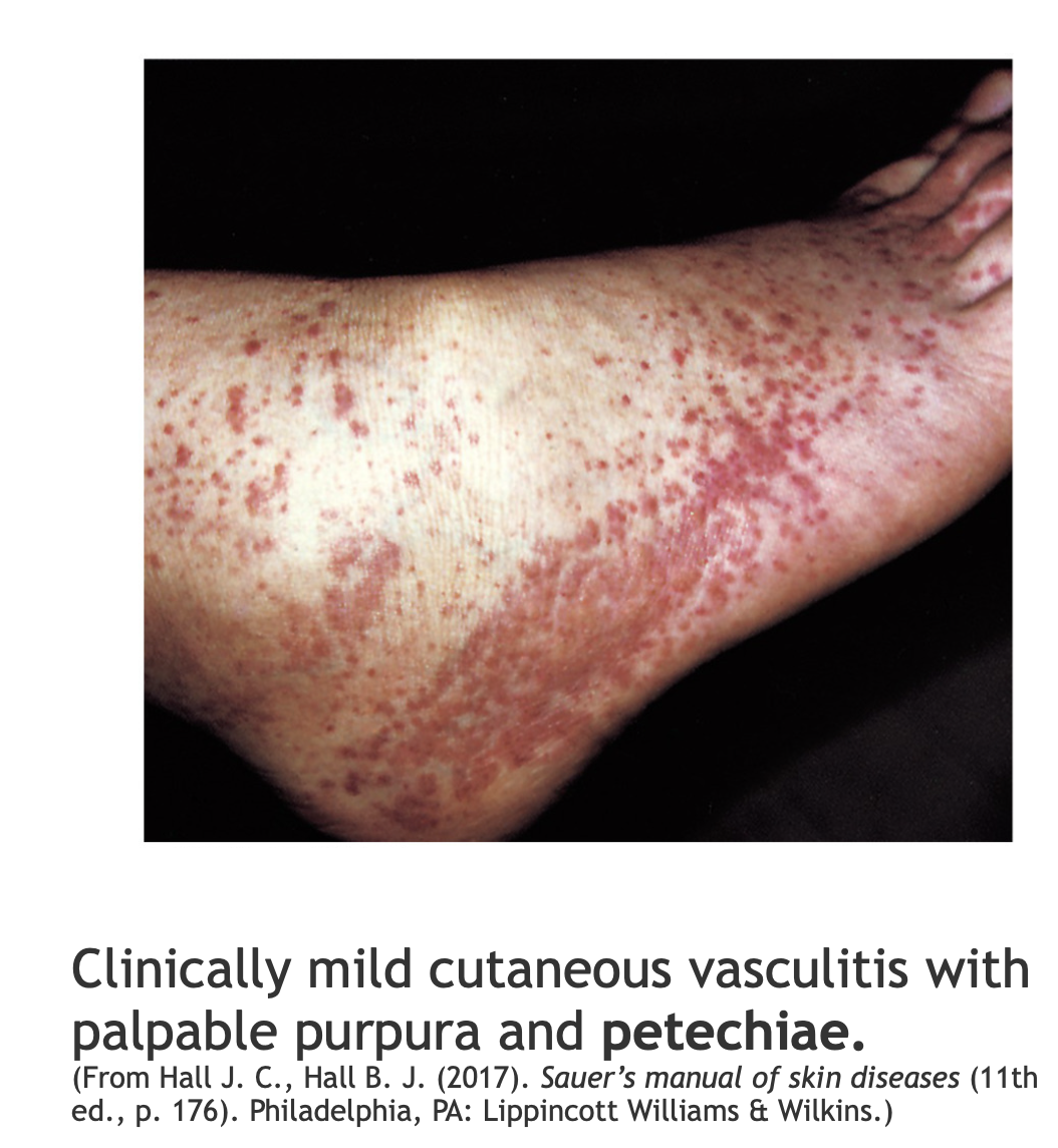 <p><strong>Bleeding Disorders: Thrombocytopenia</strong></p>