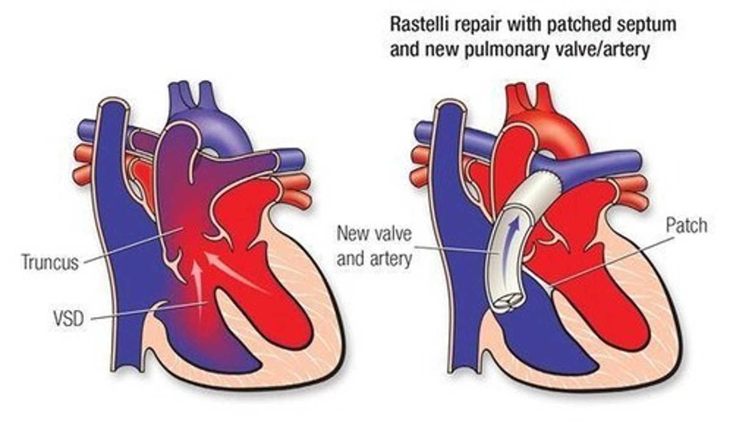 <p>(Rastelli Procedure)</p><p>• Create ARTIFICIAL PATHWAYS: RV → pulmonary artery; LV → aorta (separate circuits)</p><p>• VSD patched</p><p>• New valve and artery connection established</p>