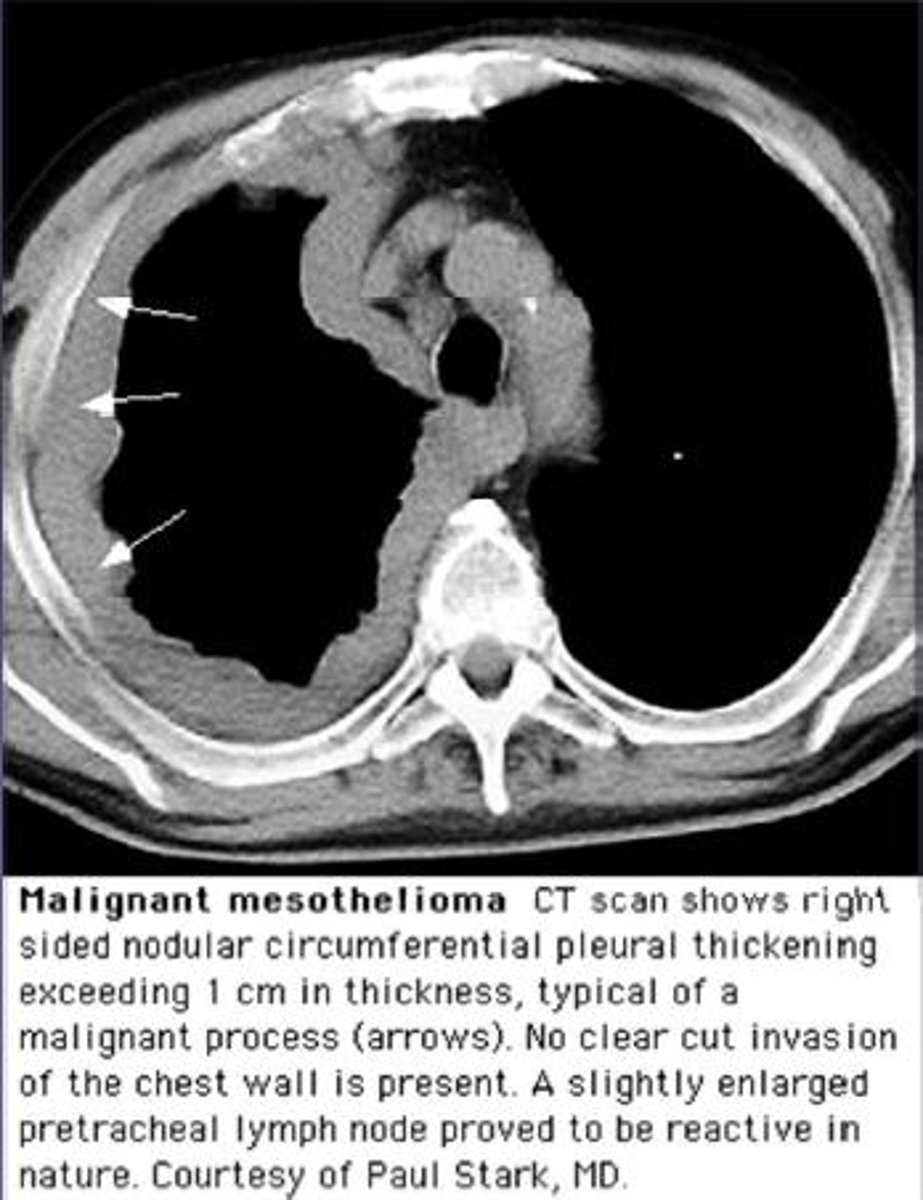 <p>Rare malignant tumor arising in the pleura and associated with asbestos exposure.</p>