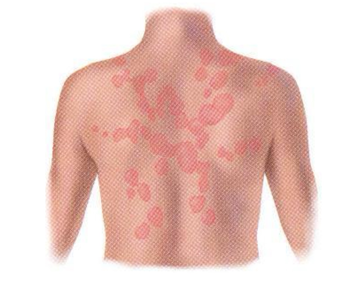 <p>what pattern of skin lesion is this? </p>