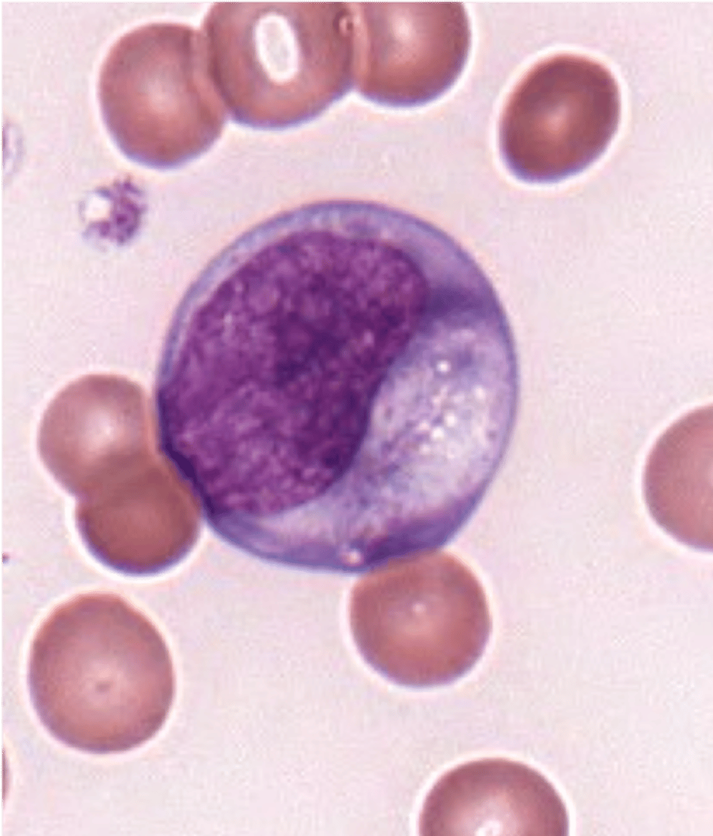 <p>- radial basophilia</p><p>-- streaks of basophilia</p><p>- remember:</p><p>immunoblast --&gt; plasma cell</p><p>NO stretched chromatin</p><p>increased in lympho-prolif</p><p>- viral illness like infectious mono, hepatitis</p>