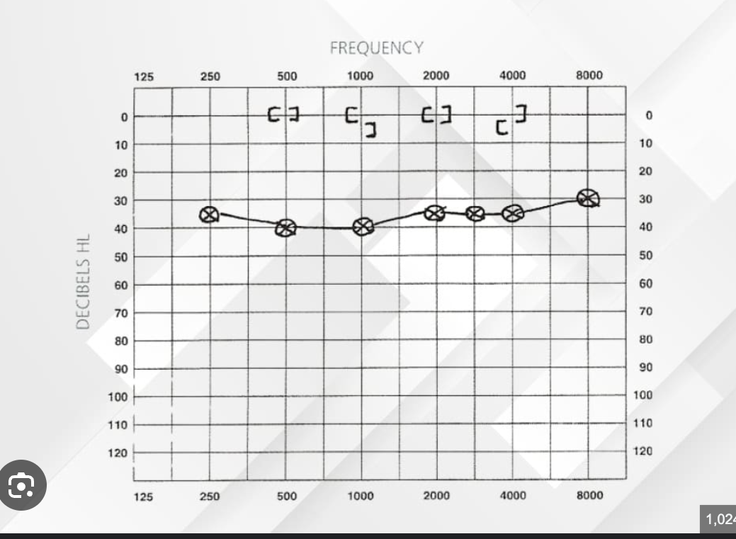 <ul><li><p>air conduction thresholds elevated </p></li><li><p>bone conduction thresholds within normal range </p></li><li><p>significant air-bone gap </p></li><li><p>(suggests issues in outer or middle ear) </p></li></ul><p></p>