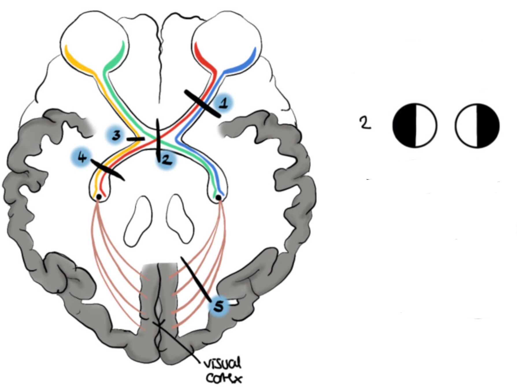<p>What visual field defect is shown</p>