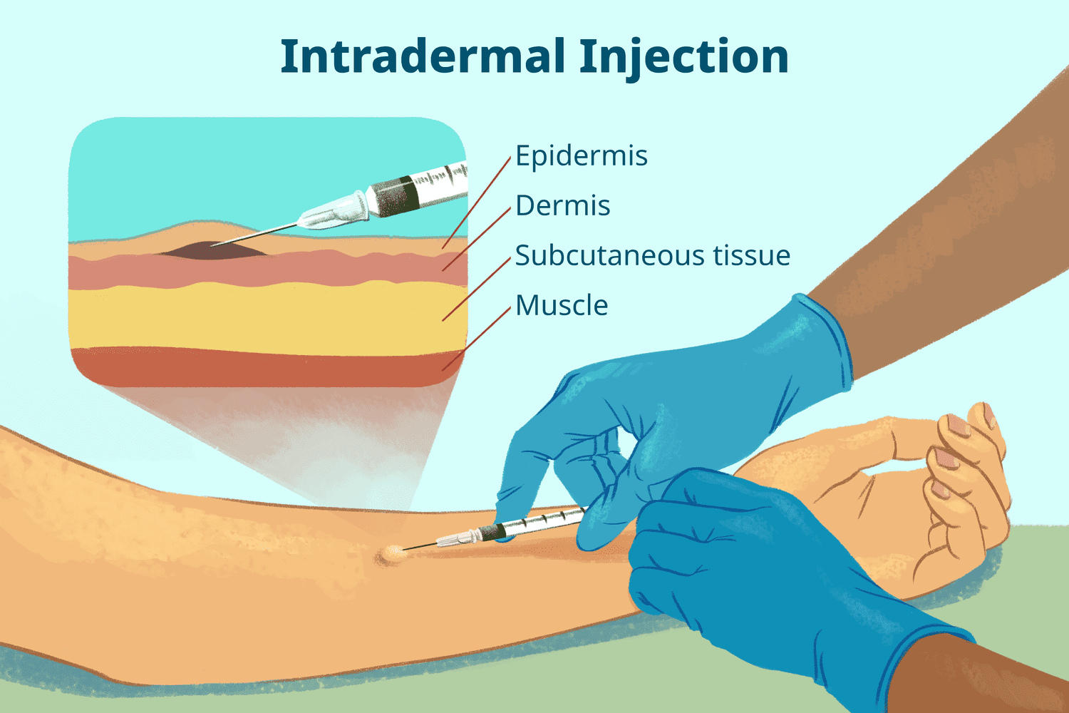are injections administered into the dermis, just below the epidermis. The ID injection route has the longest absorption time of all parenteral routes. These types of injections are used for sensitivity tests, such as TB ), allergy, and local anesthesia tests.