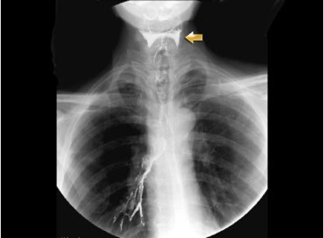 <ul><li><p>The patient needs to be NBM* on the day. No smoking or chewing gum for 8-12 hours prior</p></li><li><p>Explain procedure- hold barium in mouth until ready to swallow, raise hand to let us know you will swallow</p></li><li><p>Glasses and Jewellery removed</p></li><li><p>The fluoro table needs to be upright, with footrest and handles attached. </p></li><li><p>Barium needs to be mixed with a cup, straw and spoon handy.</p></li><li><p>Other consistencies of food such as a biscuit and banana need to be at hand</p></li><li><p>*For elderly and stoke pts there is risk of choking, aspiration pneumonia. Before beginning, check if they can safely drink water before commencing</p></li></ul><p></p>