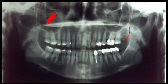 <ul><li><p><span>appears as a radiopaque bulge distal to the third molar region.</span></p><ul><li><p><span>This landmark is seen in intraoral images.</span></p></li></ul></li><li><p><span>appears as a round or ovoid radiolucency inferior to the orbit.</span></p><ul><li><p><span>It is not seen on intraoral images.</span></p></li></ul></li></ul><p></p>